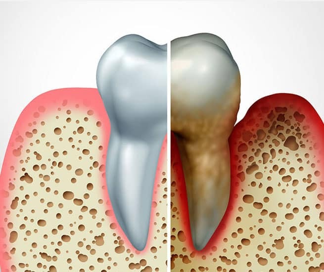 Healthy tooth compared to discolored tooth showing tooth decay and staining in bone.