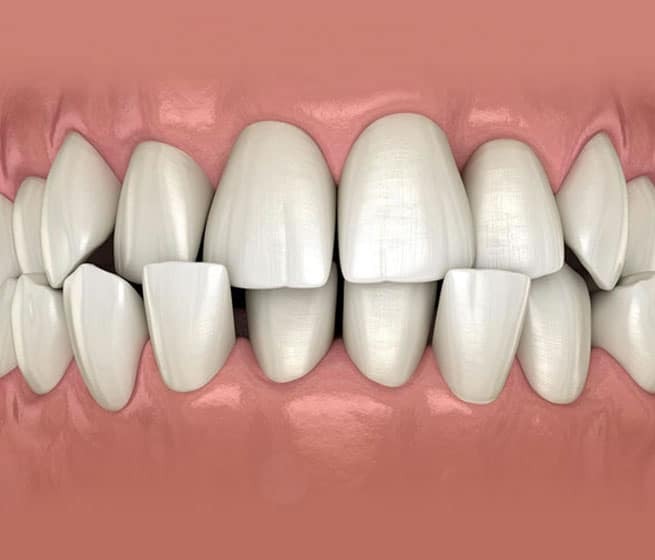 Overcrowded upper and lower teeth showing misalignment and spacing issues requiring orthodontic treatment.