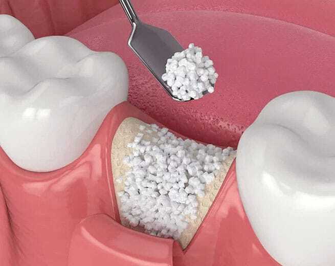Dental model showing bone graft material application between teeth with surgical instruments.