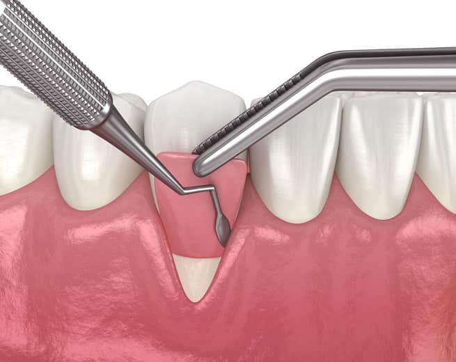Dental probe examining gum recession between teeth in periodontal illustration.