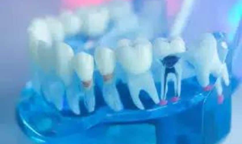 Featured image for “The Science Behind Root Canal Therapy: Exploring the Procedure”