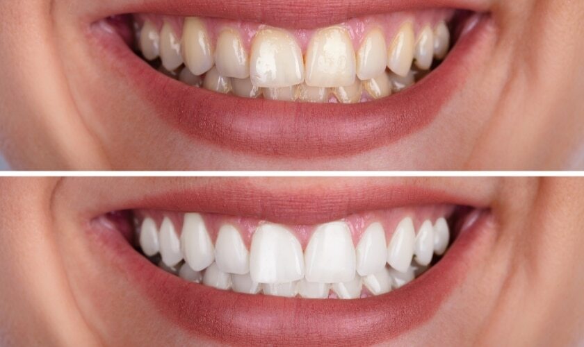 Featured image for “The Pros and Cons of Teeth Whitening: Is it Worth Considering?”