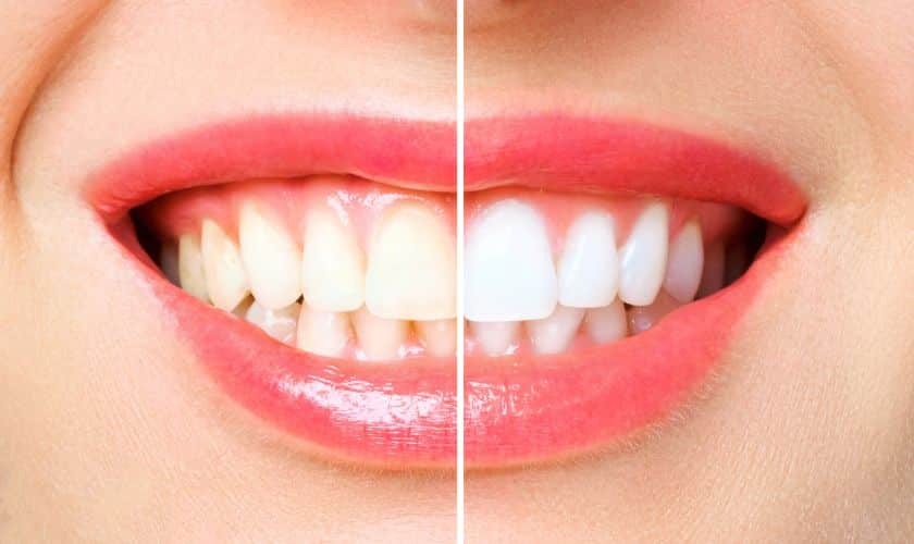 Featured image for “Where Can You Find Professional Teeth Whitening Services in Littleton?”