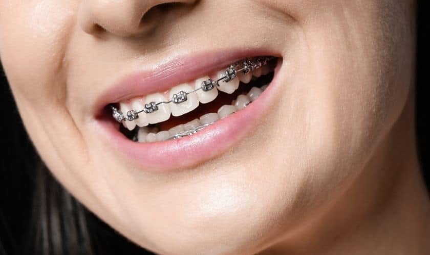 Featured image for “How Braces Benefit Adults Seeking Dental Alignment?”