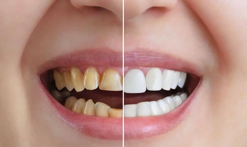 Featured image for “Teeth Whitening and Oral Health: Balancing Aesthetics with Wellness”