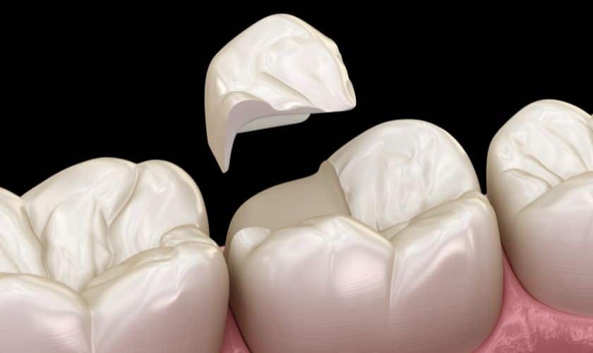 Featured image for “Cracked Teeth and Tooth Sensitivity: Exploring the Relationship”