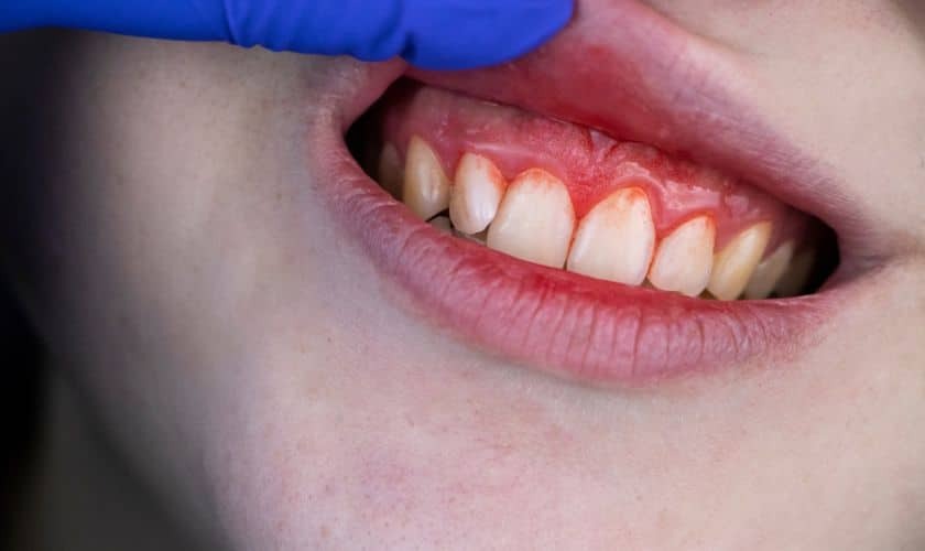 Featured image for “Diagnosing Periodontal Disease: What to Expect During a Dental Exam”