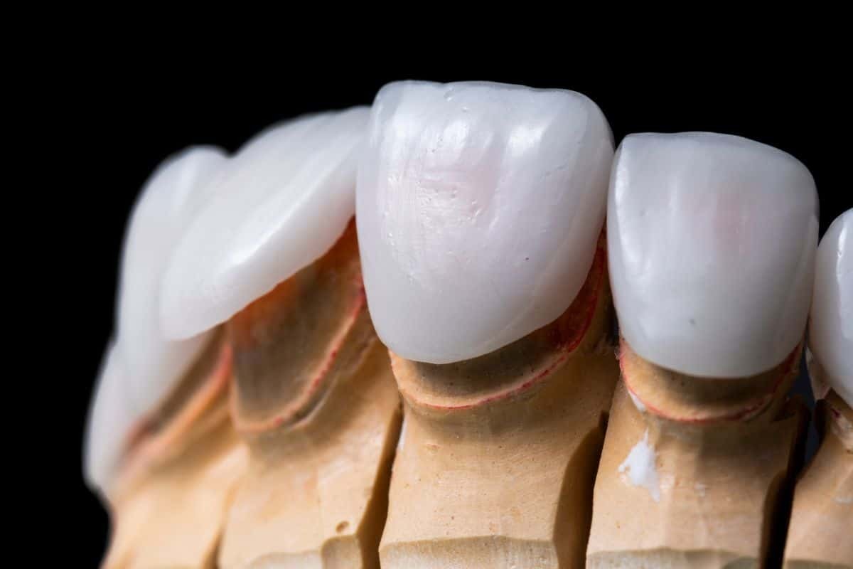 Featured image for “Are Porcelain Veneers Bad for Your Teeth?”