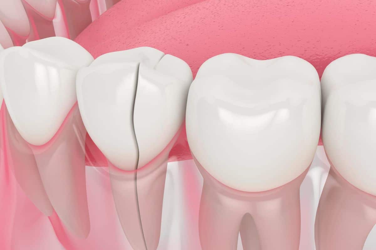 Featured image for “Cracked Tooth Repair: How Long Does the Treatment Take?”
