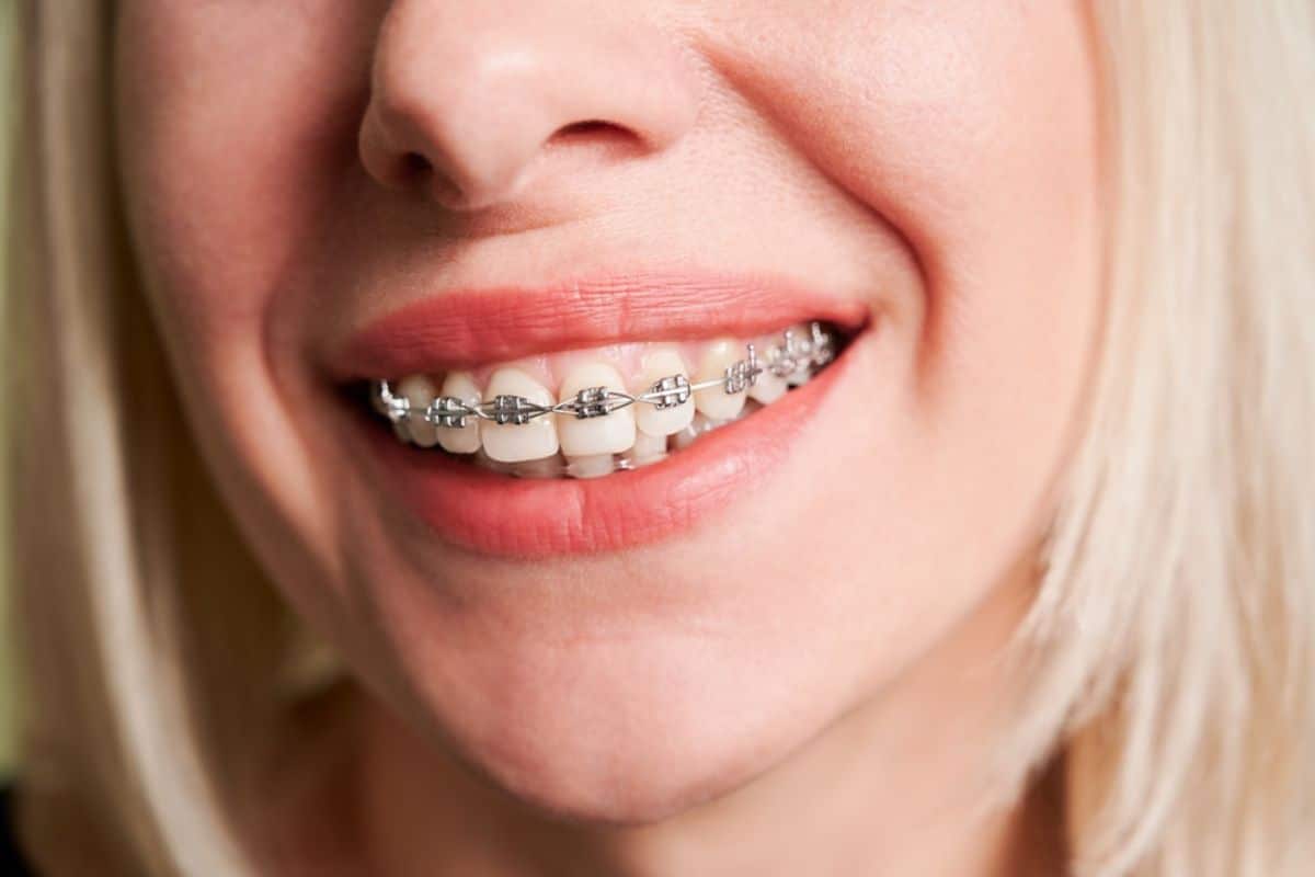 Featured image for “Overbite vs. Underbite: Effective Orthodontic Solutions”