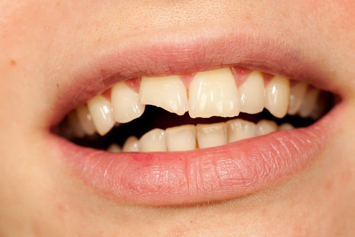 Featured image for “How to Handle a Chipped Tooth the Right Way”