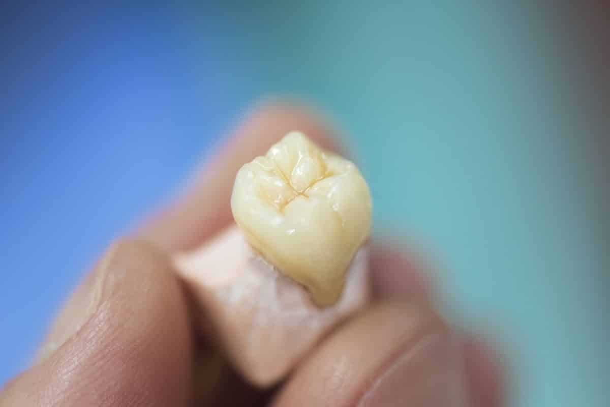 Featured image for “Dental Crown? 5 Key Indicators”