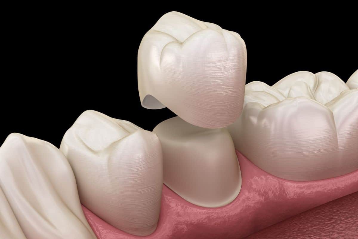Featured image for “How Do Dental Crowns Affect Your Bite?”