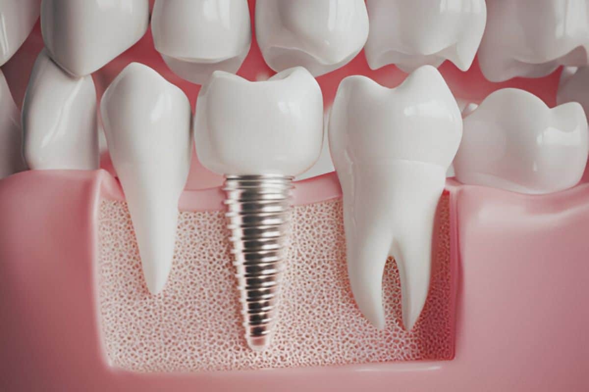 Featured image for “How Dental Implants Improve Eating and Speaking”