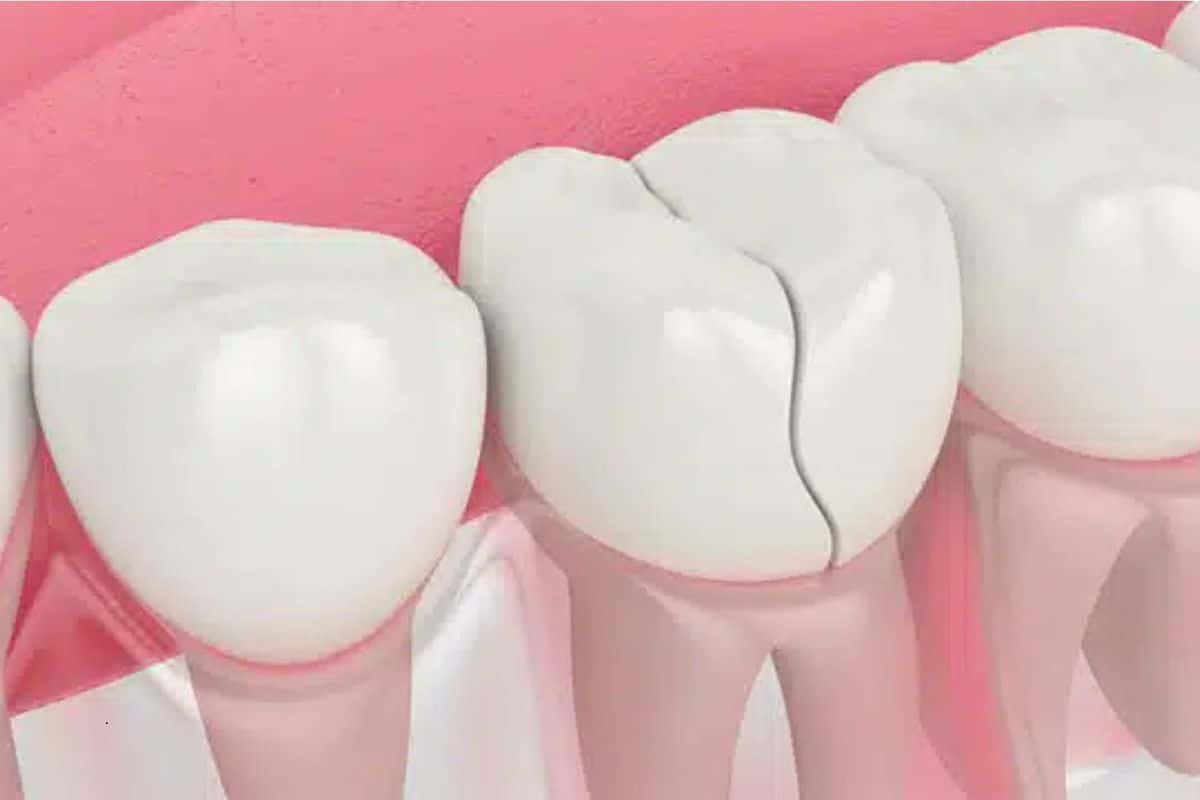 Featured image for “How Long Does It Really Take to Repair a Cracked Tooth?”