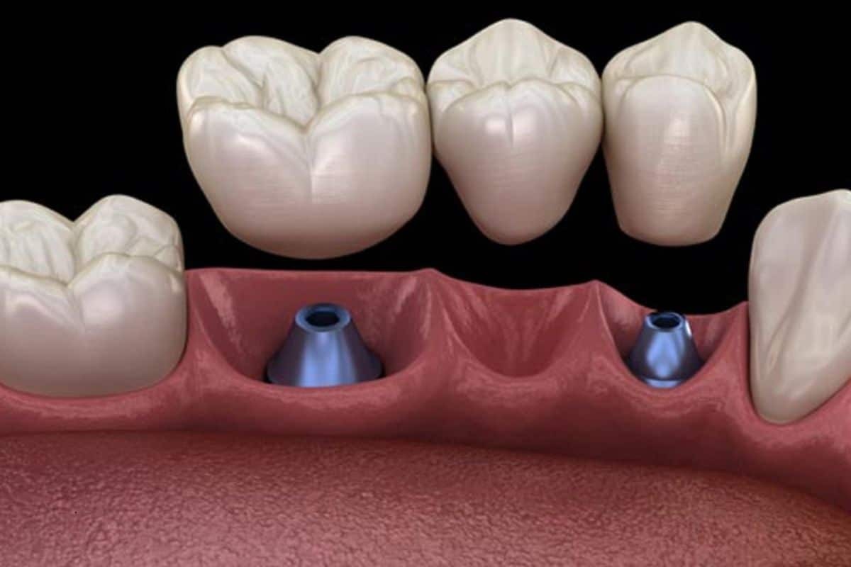 Featured image for “Life After Dental Bridges: Simple Habits for a Strong, Lasting Smile”