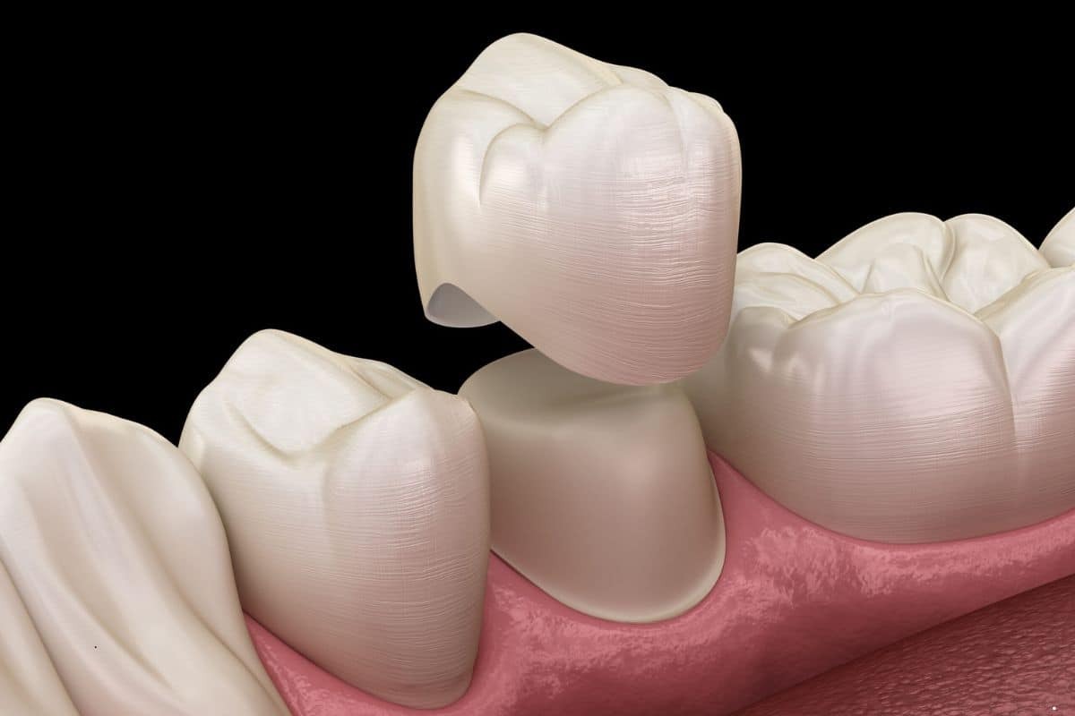 Featured image for “Can You Skip Getting a Dental Crown? Risks and Alternatives”