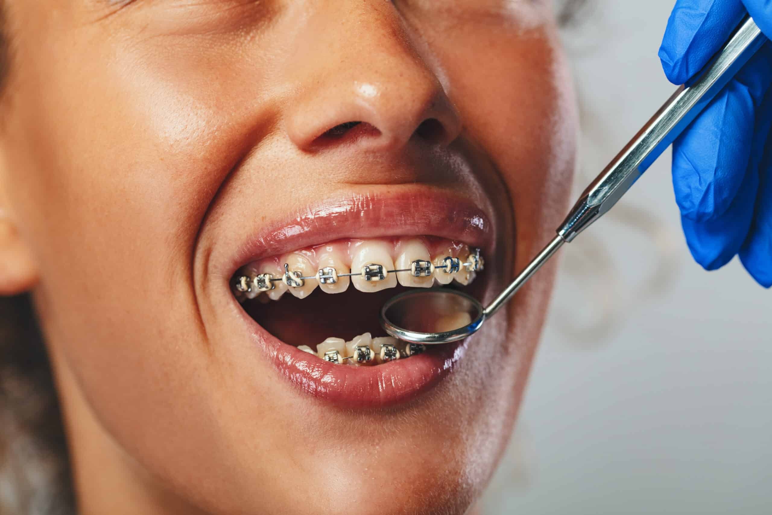 Featured image for “Common Braces Mistakes an Orthodontist Wants You to Avoid”