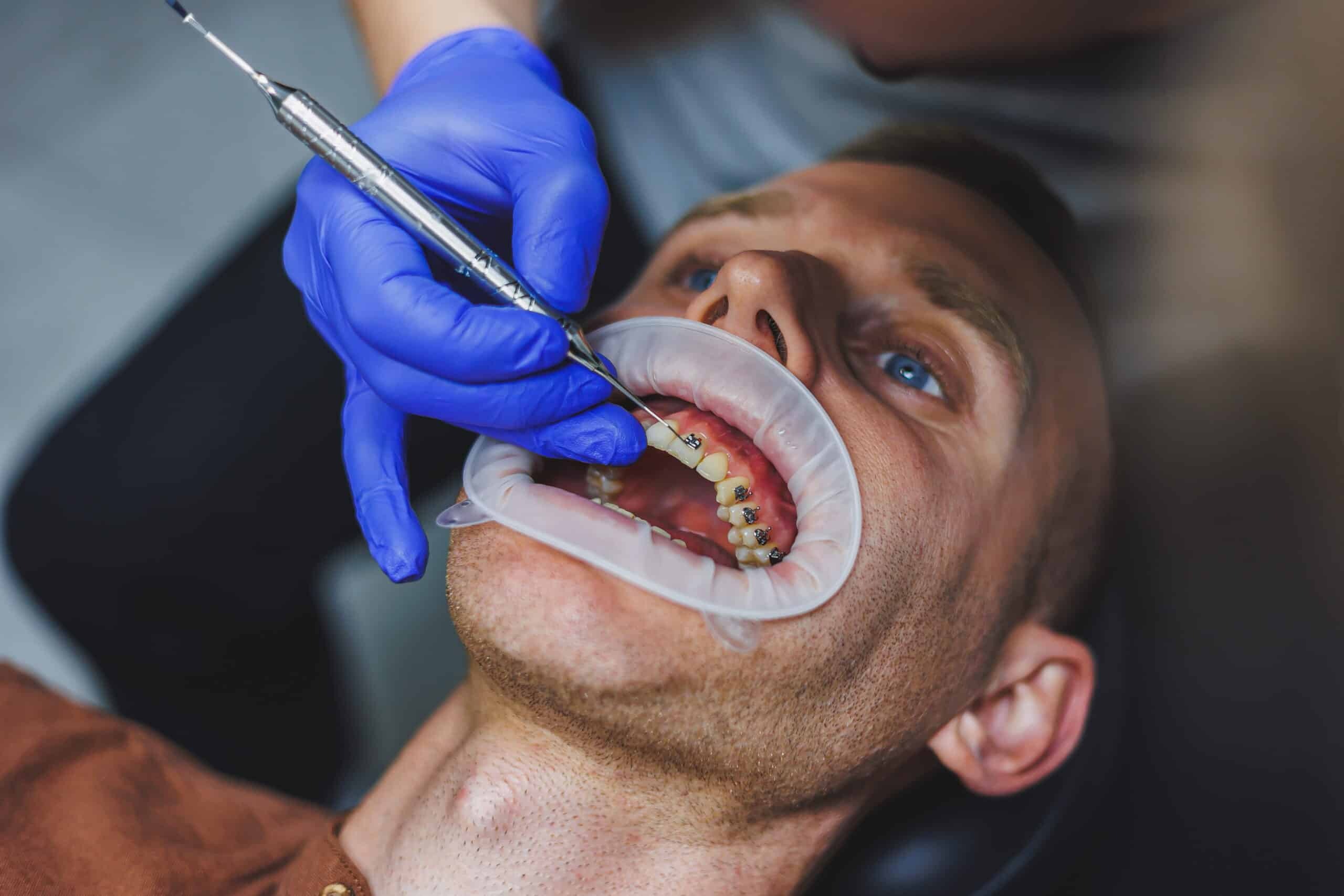 Featured image for “Why Do Teeth Shift Back After Braces?”