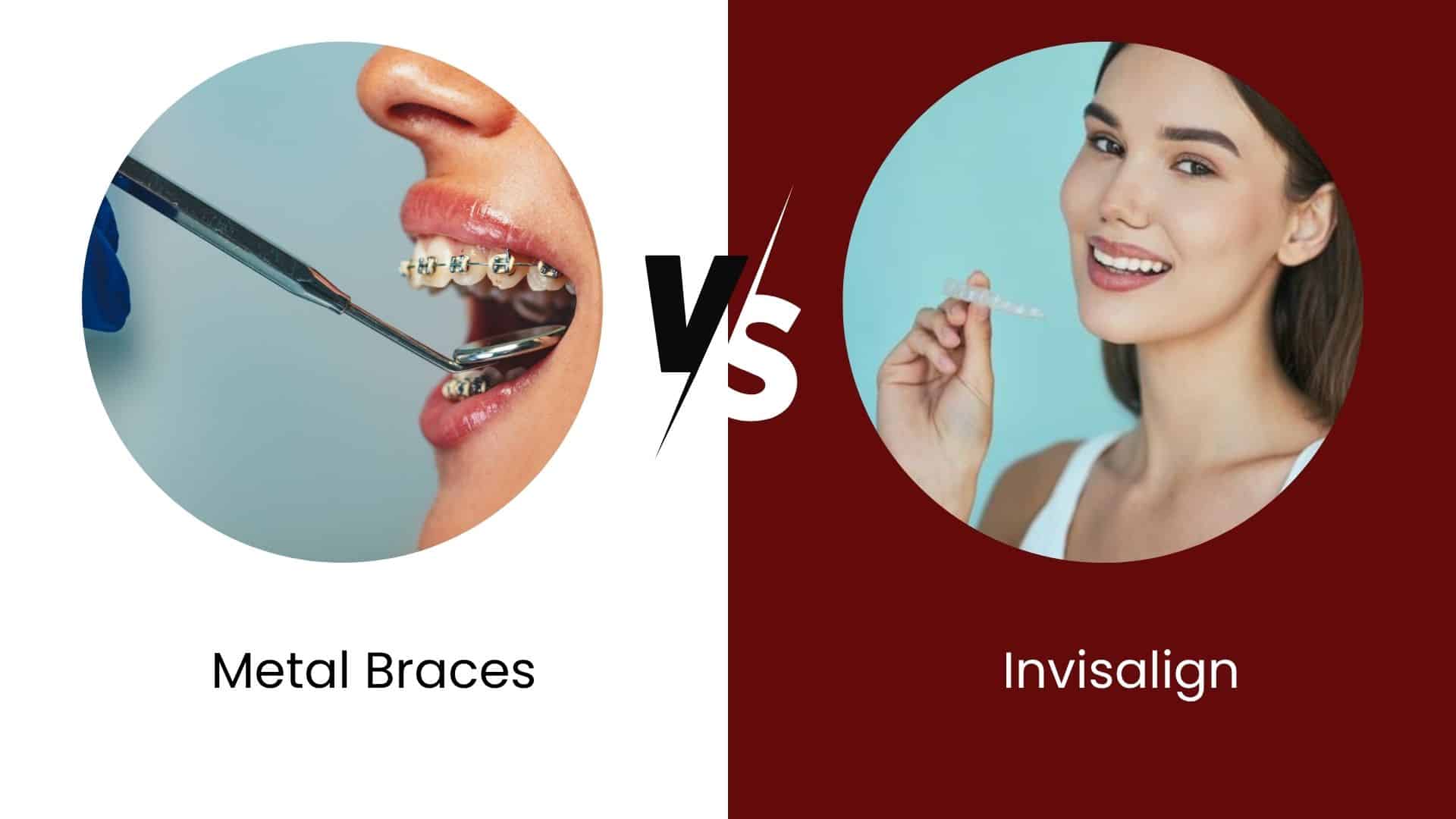 Featured image for “Metal Braces vs. Invisalign: Which Is Right for You?”