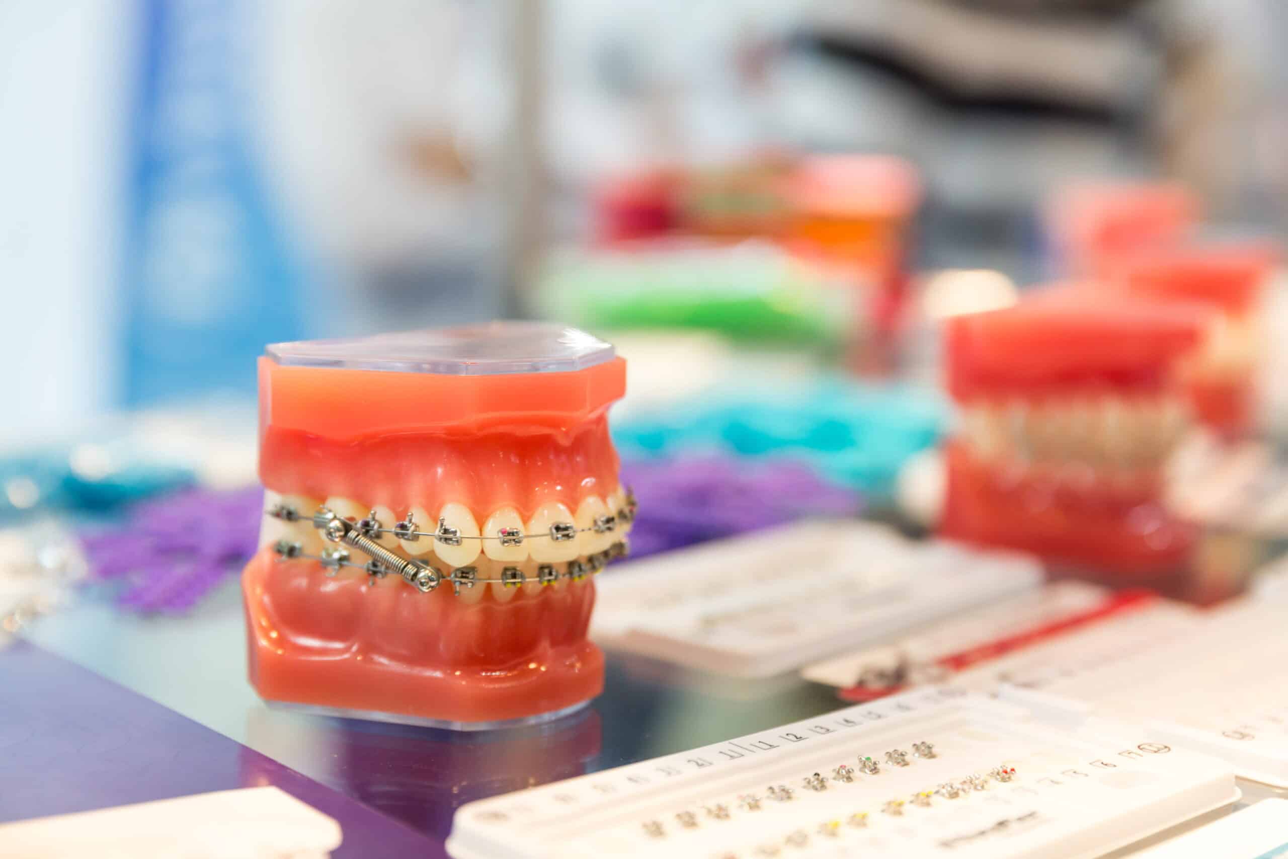 Featured image for “Braces for Teens: How to Choose the Right Time and Treatment”
